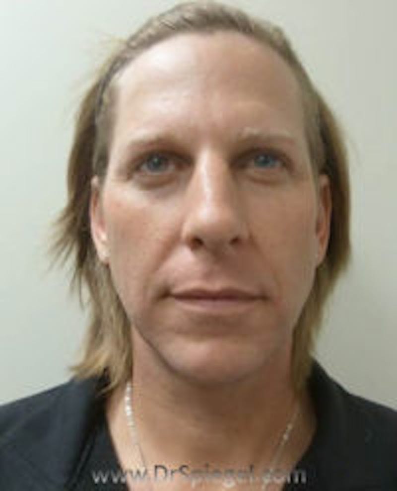 FFS Before & After Gallery - Patient 157140864 - Image 1