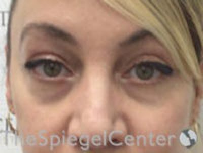 Tear Trough / Under Eye Fillers Before & After Gallery - Patient 157140866 - Image 1