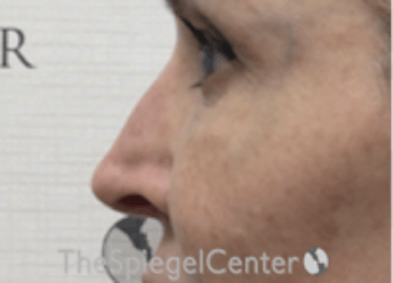 Non-Surgical Rhinoplasty / Nose Filler Before & After Gallery - Patient 157140865 - Image 3