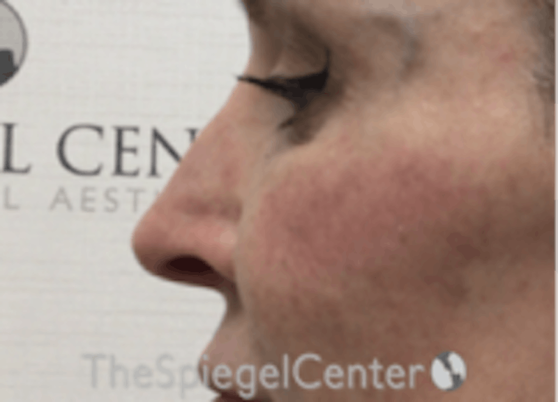 Non-Surgical Rhinoplasty / Nose Filler Before & After Gallery - Patient 157140865 - Image 4