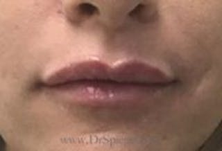 Lip Filler Before & After Gallery - Patient 157140868 - Image 2