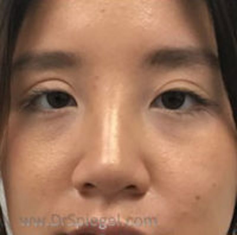Non-Surgical Rhinoplasty / Nose Filler Before & After Gallery - Patient 157140870 - Image 2