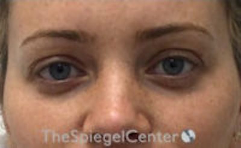 Tear Trough / Under Eye Fillers Before & After Gallery - Patient 157140872 - Image 1