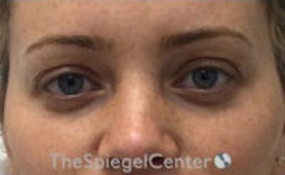 Tear Trough / Under Eye Fillers Before & After Gallery - Patient 157140872 - Image 1