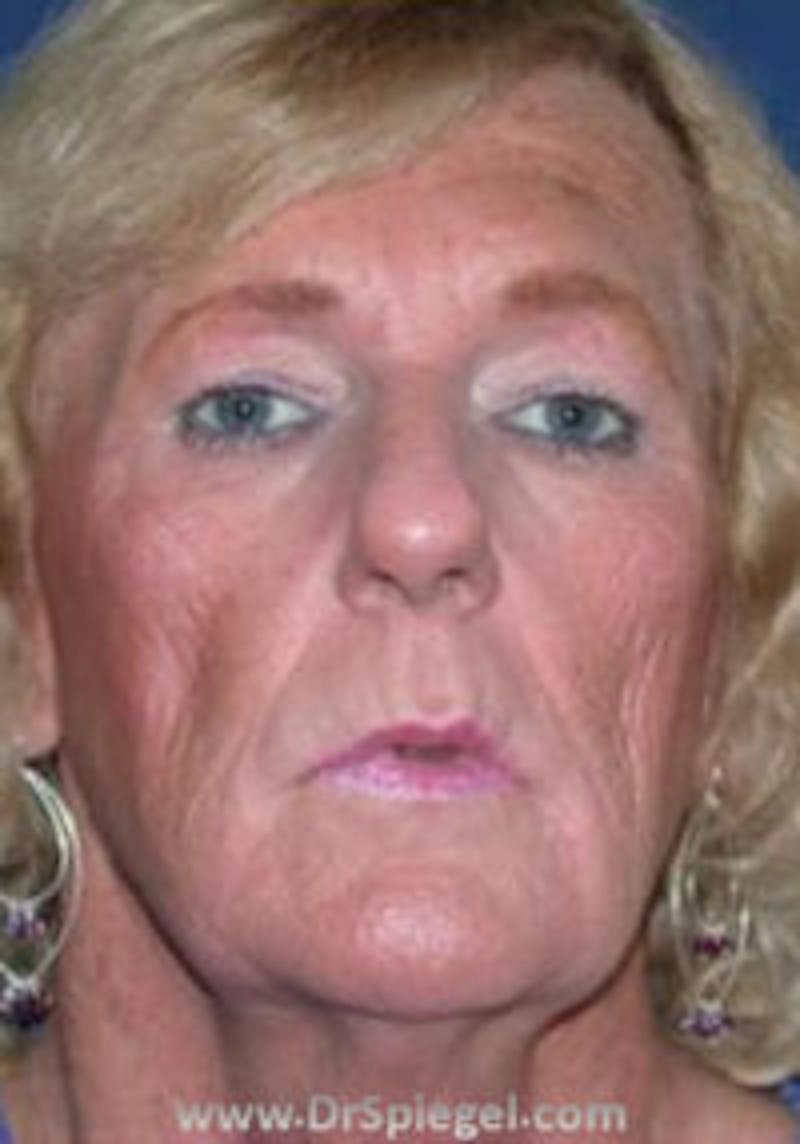 FFS Before & After Gallery - Patient 157140871 - Image 1