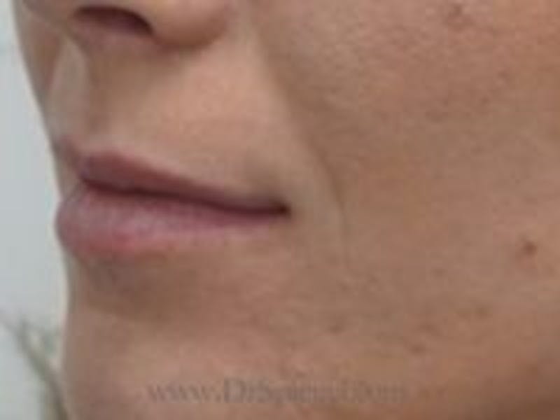 Lip Filler Before & After Gallery - Patient 157140873 - Image 3