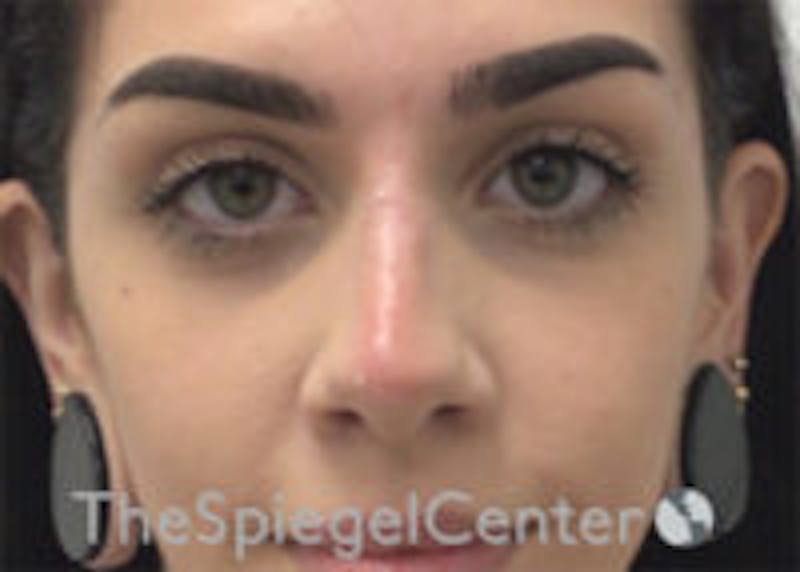 Non-Surgical Rhinoplasty / Nose Filler Before & After Gallery - Patient 157140876 - Image 2