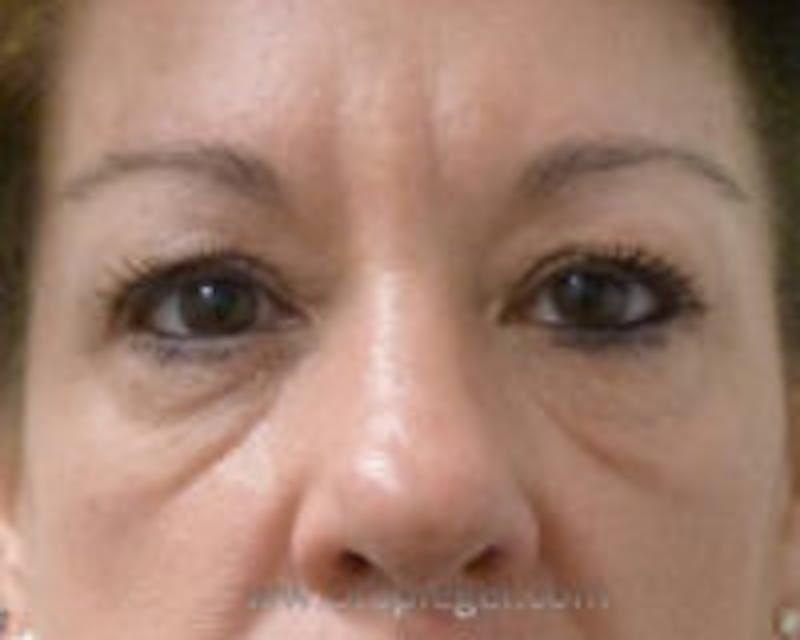 Tear Trough / Under Eye Fillers Before & After Gallery - Patient 157140877 - Image 1