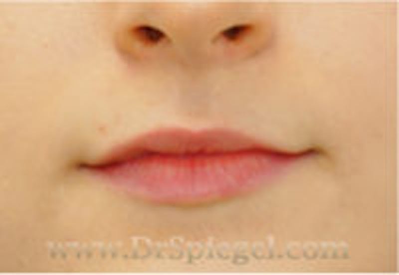 Lip Filler Before & After Gallery - Patient 157140878 - Image 1