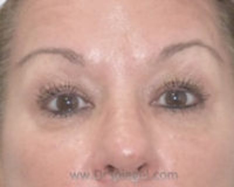 Tear Trough / Under Eye Fillers Before & After Gallery - Patient 157140877 - Image 2