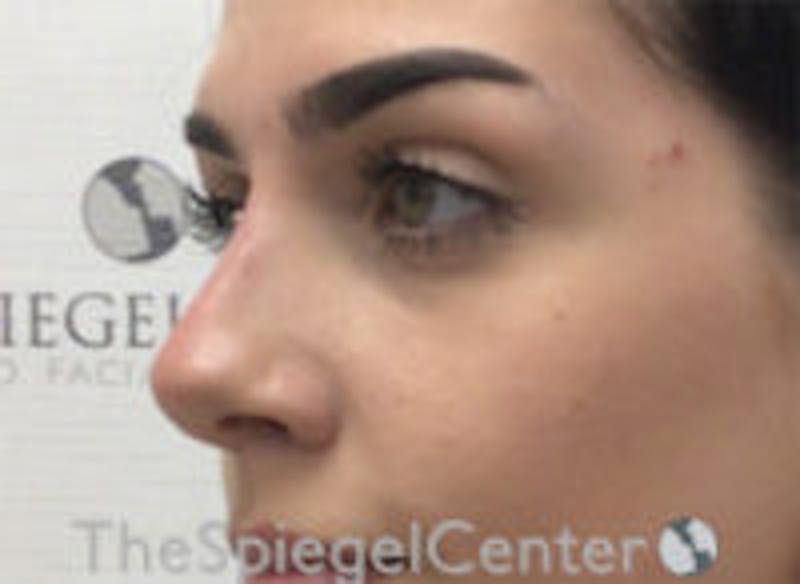 Non-Surgical Rhinoplasty / Nose Filler Before & After Gallery - Patient 157140876 - Image 4