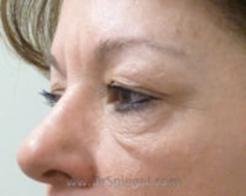 Tear Trough / Under Eye Fillers Before & After Gallery - Patient 157140877 - Image 3