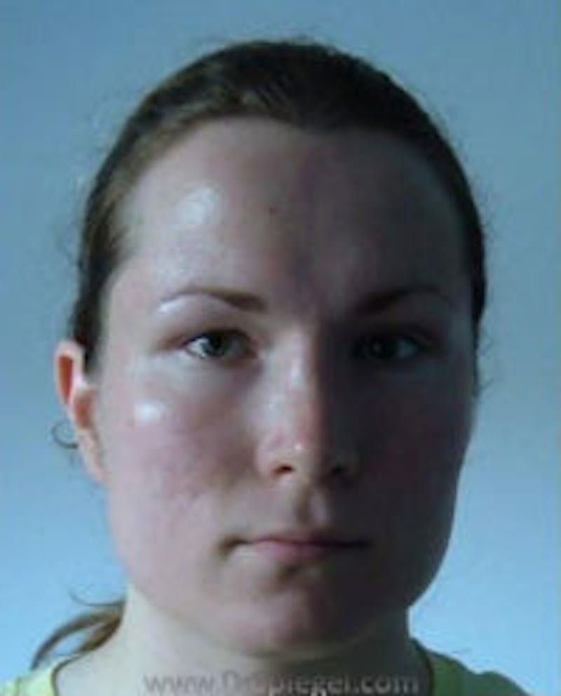 FFS Before & After Gallery - Patient 157140879 - Image 1