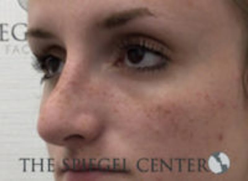 Non-Surgical Rhinoplasty / Nose Filler Before & After Gallery - Patient 157140880 - Image 3