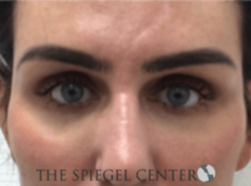 Tear Trough / Under Eye Fillers Before & After Gallery - Patient 157140882 - Image 2