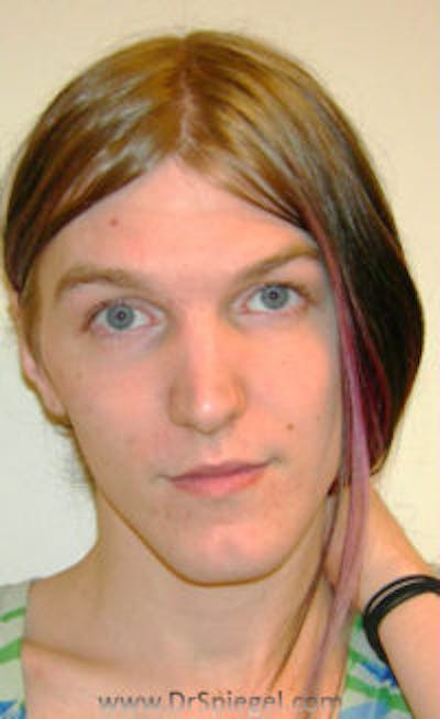 FFS Before & After Gallery - Patient 157140881 - Image 1