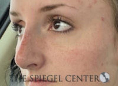 Non-Surgical Rhinoplasty / Nose Filler Before & After Gallery - Patient 157140880 - Image 4