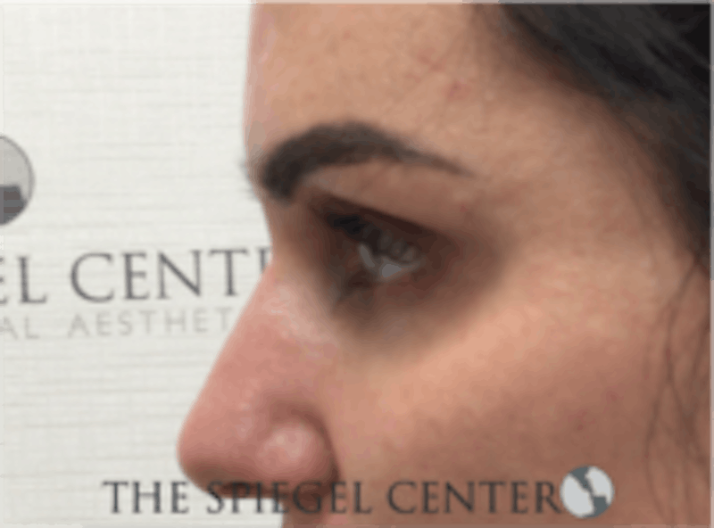 Tear Trough / Under Eye Fillers Before & After Gallery - Patient 157140882 - Image 3