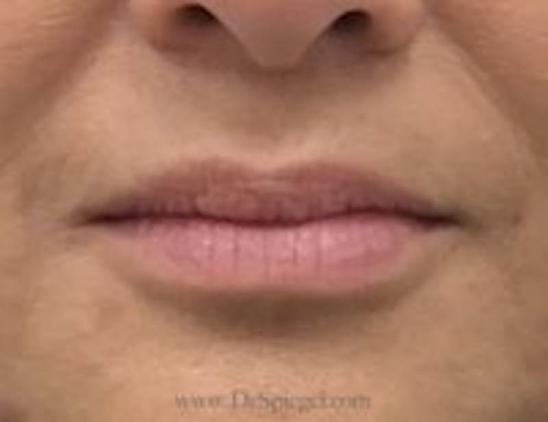 Lip Filler Before & After Gallery - Patient 157140884 - Image 2