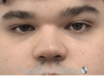 Non-Surgical Rhinoplasty / Nose Filler Before & After Gallery - Patient 157140887 - Image 1