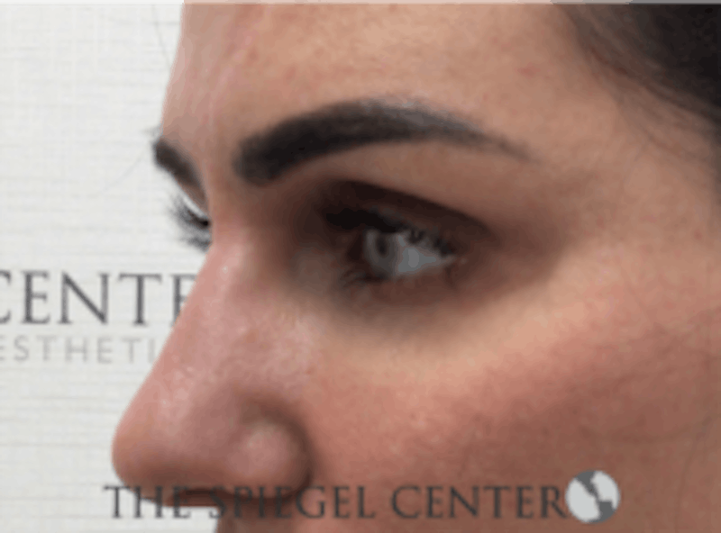 Tear Trough / Under Eye Fillers Before & After Gallery - Patient 157140882 - Image 4
