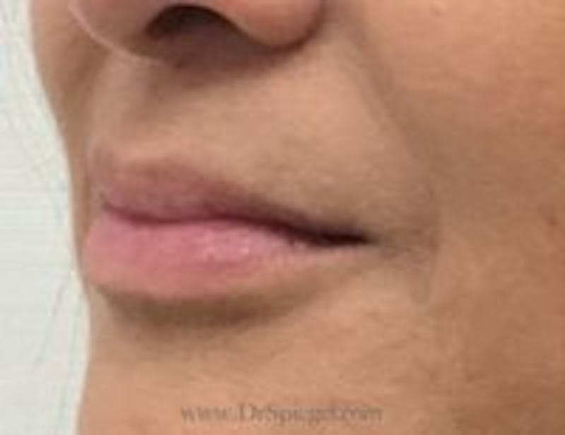 Lip Filler Before & After Gallery - Patient 157140884 - Image 4