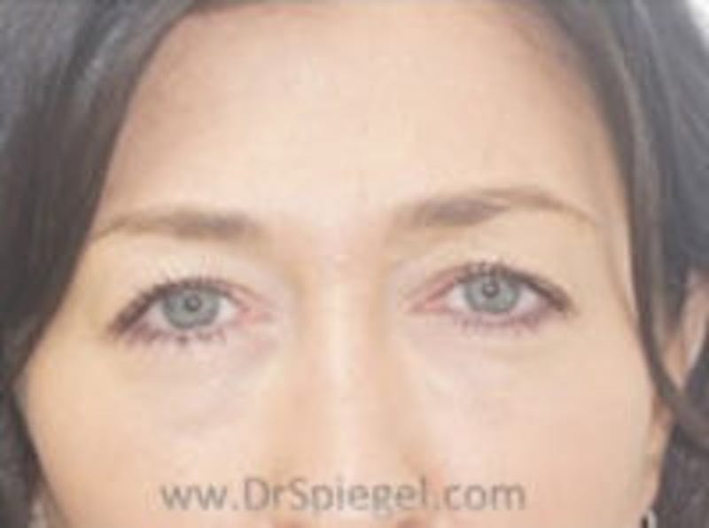 Tear Trough / Under Eye Fillers Before & After Gallery - Patient 157140888 - Image 1
