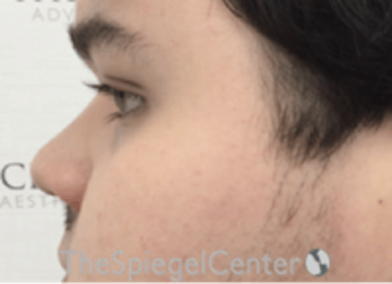 Non-Surgical Rhinoplasty / Nose Filler Before & After Gallery - Patient 157140887 - Image 3