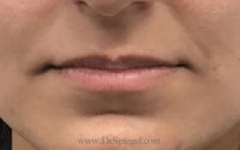 Lip Filler Before & After Gallery - Patient 157140891 - Image 1