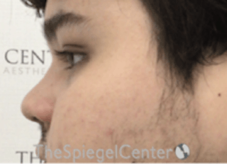 Non-Surgical Rhinoplasty / Nose Filler Before & After Gallery - Patient 157140887 - Image 4
