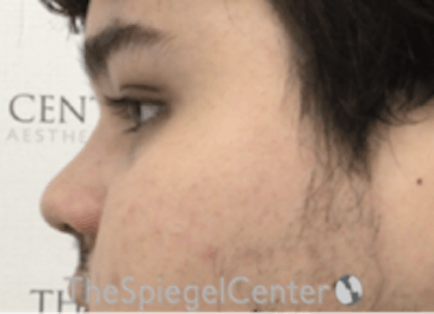 Non-Surgical Rhinoplasty / Nose Filler Before & After Gallery - Patient 157140887 - Image 4