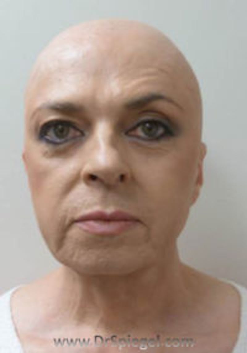FFS Before & After Gallery - Patient 157140889 - Image 1