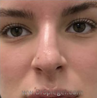 Non-Surgical Rhinoplasty / Nose Filler Before & After Gallery - Patient 157140893 - Image 1