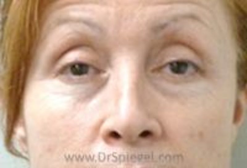 Tear Trough / Under Eye Fillers Before & After Gallery - Patient 157140894 - Image 1