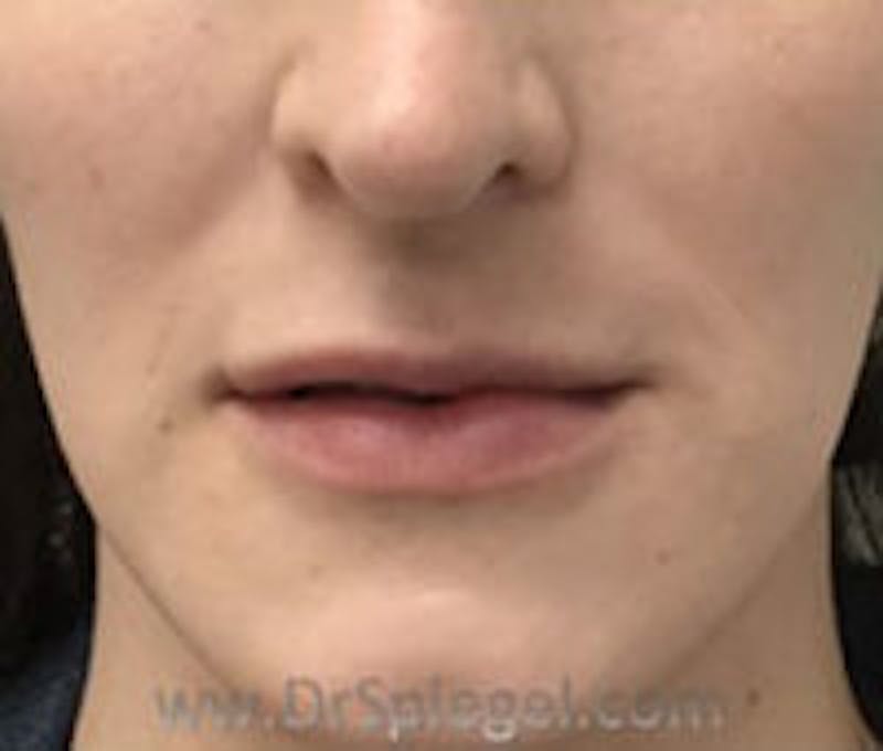 Lip Filler Before & After Gallery - Patient 157140895 - Image 1