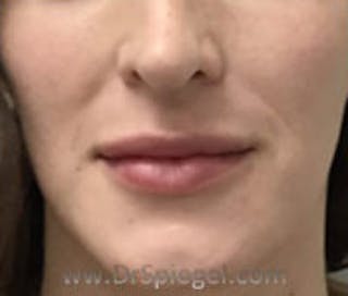Lip Filler Before & After Gallery - Patient 157140895 - Image 2