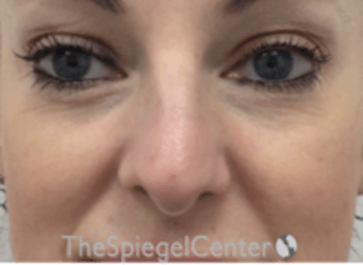 Non-Surgical Rhinoplasty / Nose Filler Before & After Gallery - Patient 157140897 - Image 1