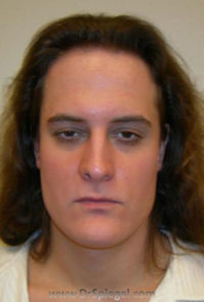 FFS Before & After Gallery - Patient 157140896 - Image 1