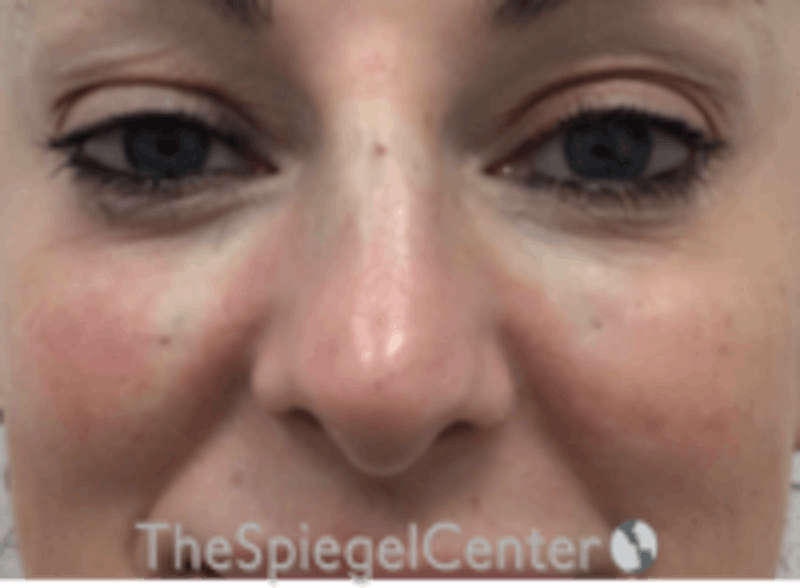 Non-Surgical Rhinoplasty / Nose Filler Before & After Gallery - Patient 157140897 - Image 2