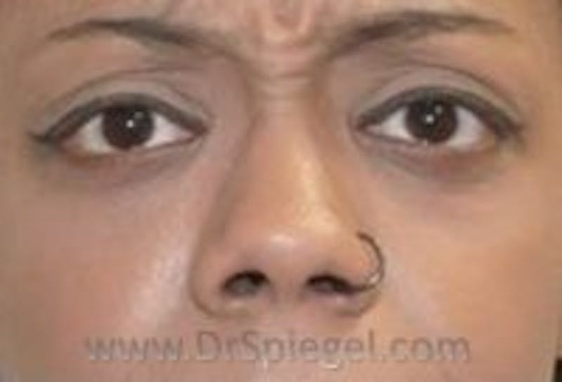 Tear Trough / Under Eye Fillers Before & After Gallery - Patient 157140898 - Image 1