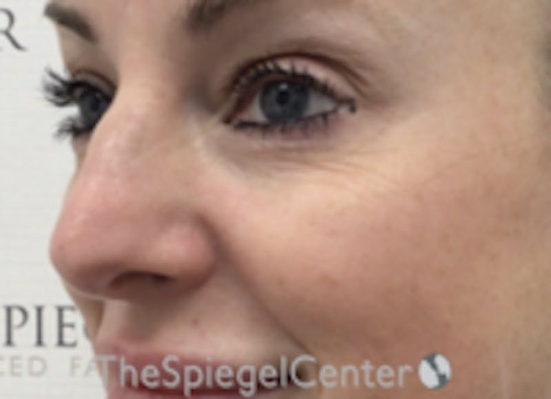 Non-Surgical Rhinoplasty / Nose Filler Before & After Gallery - Patient 157140897 - Image 3