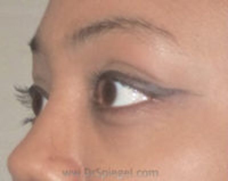 Tear Trough / Under Eye Fillers Before & After Gallery - Patient 157140898 - Image 4