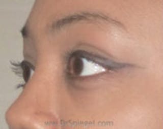 Tear Trough / Under Eye Fillers Before & After Gallery - Patient 157140898 - Image 4