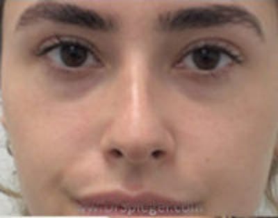 Non-Surgical Rhinoplasty / Nose Filler Before & After Gallery - Patient 157140901 - Image 1