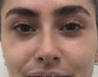 Non-Surgical Rhinoplasty / Nose Filler Before & After Gallery - Patient 157140901 - Image 2