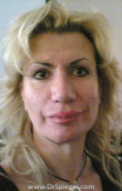 FFS Before & After Gallery - Patient 157140902 - Image 1