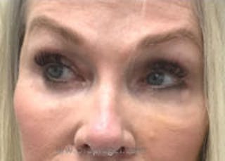 Tear Trough / Under Eye Fillers Before & After Gallery - Patient 157140903 - Image 2