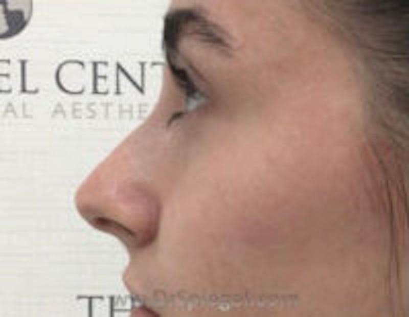 Non-Surgical Rhinoplasty / Nose Filler Before & After Gallery - Patient 157140901 - Image 4