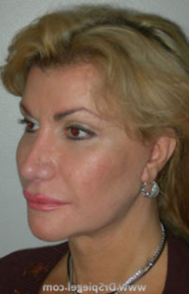 FFS Before & After Gallery - Patient 157140902 - Image 2