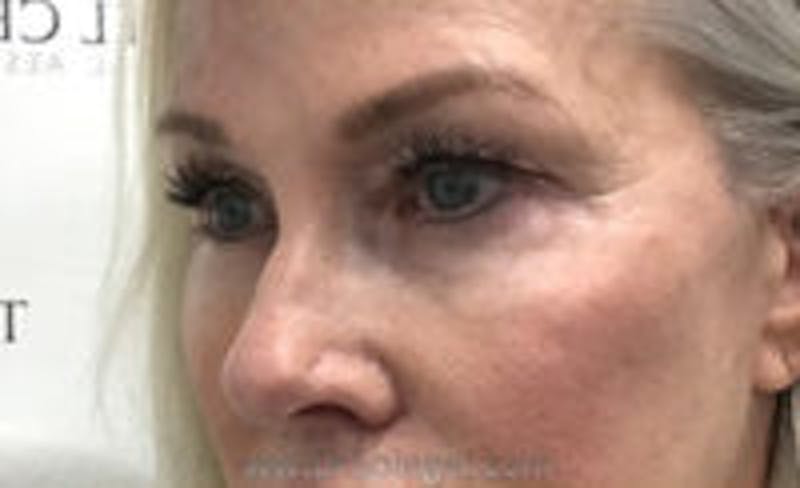 Tear Trough / Under Eye Fillers Before & After Gallery - Patient 157140903 - Image 3